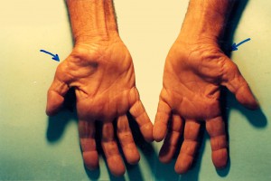  Spending long hours using computer keyboard and mouse can cause Carpal Tunnel Syndrome.